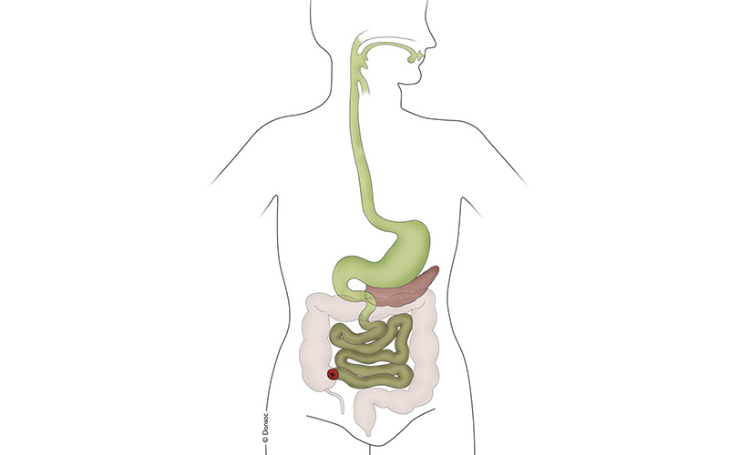 ileostomie-stoma-therapie-medicare